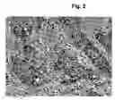 Fig. 03 - Method of pre-sensitizing cancer prior to treament with radiation and/or chemotherapy and a novel cytokine mixture