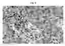 Fig. 09 - Method of pre-sensitizing cancer prior to treament with radiation and/or chemotherapy and a novel cytokine mixture