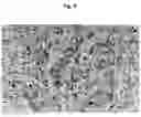 Fig. 10 - Method of pre-sensitizing cancer prior to treament with radiation and/or chemotherapy and a novel cytokine mixture