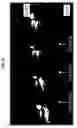 Fig. 14 - Methods and compositions for treating intervertebral disc degeneration
