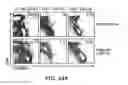 Fig. 49 - Hematopoietic stem cell gene therapy