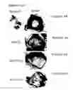 Fig. 09 - Methods of treating arthritis and diabetic retinopathy with αβ-specific antibodies