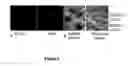 Fig. 07 - Use of JAG2 expression in diagnosis of plasma cell disorders