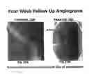 Fig. 13 - Medical implants and methods for regulating the tissue response to vascular closure devices