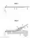 Fig. 02 - Endoscopic balloon insertion device for treatment of obesity and insertion technique of the same