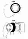 Fig. 04 - Endoscopic balloon insertion device for treatment of obesity and insertion technique of the same