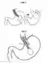 Fig. 05 - Endoscopic balloon insertion device for treatment of obesity and insertion technique of the same