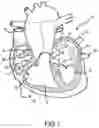 Fig. 02 - Ablation catheter electrode arrangement
