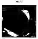 Fig. 11 - Method and apparatus for detecting ischemia