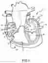 Fig. 02 - Steerable and shapable catheter employing fluid force
