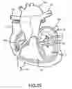 Fig. 14 - Steerable and shapable catheter employing fluid force