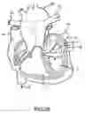 Fig. 15 - Steerable and shapable catheter employing fluid force