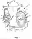 Fig. 02 - Ablation fluid manifold for ablation catheter
