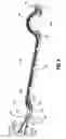 Fig. 05 - Electrosurgical instrument which reduces effects to adjacent tissue structures