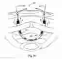 Fig. 06 - System for securing sutures, grafts and soft tissue to bone and periosteum