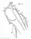 Fig. 09 - Endovascular stapler