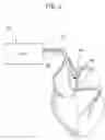 Fig. 03 - Bachmann's bundle electrode for atrial defibrillation