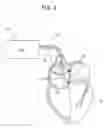 Fig. 04 - Bachmann's bundle electrode for atrial defibrillation
