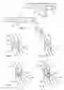 Fig. 04 - Exitable lumen guide wire sheath and method of use