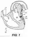Fig. 02 - Methods and devices for delivering a ventricular stent