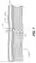 Fig. 08 - Methods and devices for delivering a ventricular stent