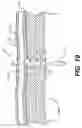 Fig. 11 - Methods and devices for delivering a ventricular stent