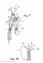 Fig. 09 - Methods, materials and apparatus for deterring or preventing endoleaks following endovascular graft implantation