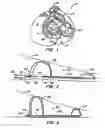 Fig. 02 - Device, system and method to affect the mitral valve annulus of a heart
