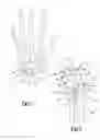 Fig. 02 - Method and apparatus for wrist arthroplasty