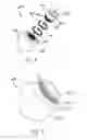 Fig. 06 - Femoral head assembly with variable offset
