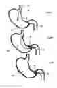 Fig. 08 - Pyloric valve corking device and method