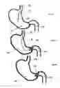 Fig. 09 - Pyloric valve corking device and method