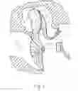Fig. 02 - Implanted hearing aids