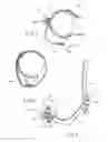 Fig. 08 - Apparatus for correction of leg deformities