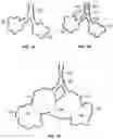 Fig. 02 - Methods and devices for maintaining patency of surgically created channels in a body organ