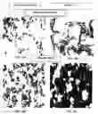 Fig. 12 - Monoclonal antibodies and cell surface antigens for the detection and treatment of small cell lung cancer (SCLC)