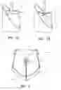Fig. 02 - Minimally invasive valve replacement system