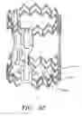 Fig. 41 - Minimally invasive valve replacement system