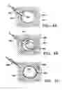 Fig. 07 - Biopsy site marker