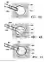 Fig. 09 - Biopsy site marker