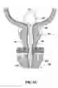 Fig. 06 - Implantable devices and methods for treating urinary incontinence