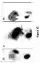 Fig. 43 - Mechanism-based targeted pancreatic beta cell imaging and therapy