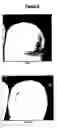 Fig. 04 - Use of topical compositions for the control of microbial diseases of the nail