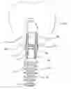 Fig. 01 - Dental implant system