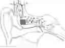 Fig. 01 - Implantable hearing aid transducer interface