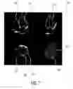 Fig. 08 - Ultrasound diagnostic imaging system and method for 3D qualitative display of 2D border tracings