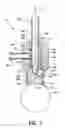 Fig. 08 - Ultrasound probe positioning immersion shell