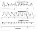 Fig. 01 - Using chest velocity to process physiological signals to remove chest compression artifacts