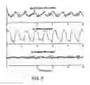 Fig. 03 - Using chest velocity to process physiological signals to remove chest compression artifacts