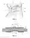 Fig. 04 - Cervical collar having enhanced lateral support